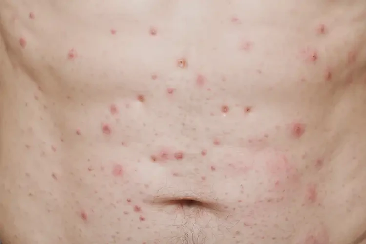 男性肚子上偶爾起濕疹不管它會(huì)自己自愈嗎(圖4)