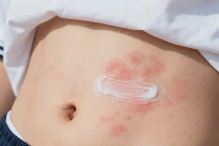 大學(xué)生肚子上長(zhǎng)濕疹可以徹底自愈嗎(圖3)