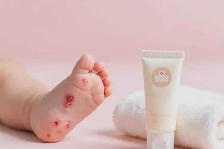 寶寶腳上長濕疹可以徹底自愈嗎(圖3)