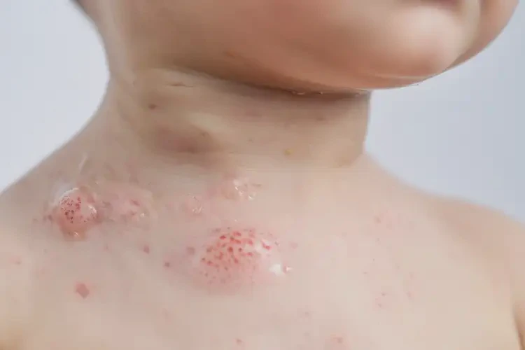 幼兒脖子上出現(xiàn)濕疹可不可以徹底自愈(圖3)