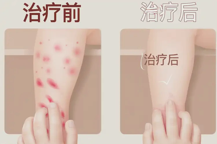 小兒四肢長(zhǎng)濕疹能夠治愈嗎(圖4)