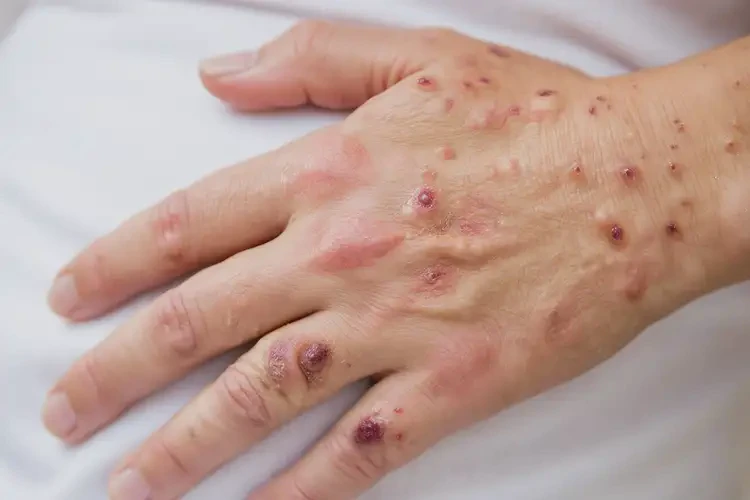 產(chǎn)婦手上起濕疹能夠徹底治愈嗎(圖4)