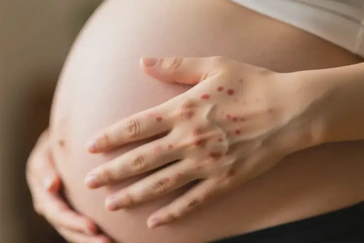 孕婦手上偶爾長(zhǎng)濕疹不管它會(huì)自己好嗎(圖3)