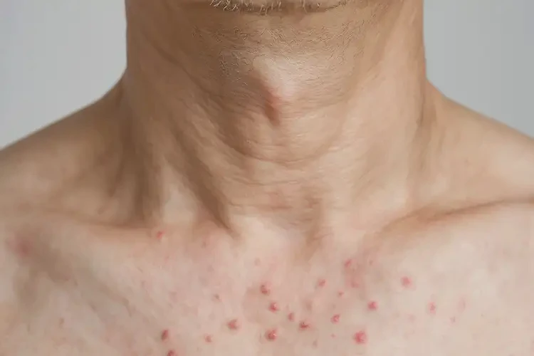 男性脖子偶尔起湿疹能靠自己自愈吗(图3)