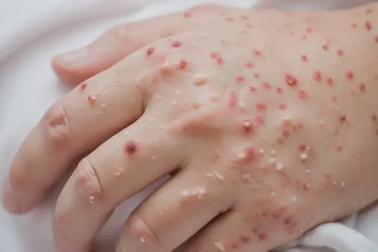 產(chǎn)婦手上偶爾長(zhǎng)濕疹不管它會(huì)自己痊愈嗎(圖4)