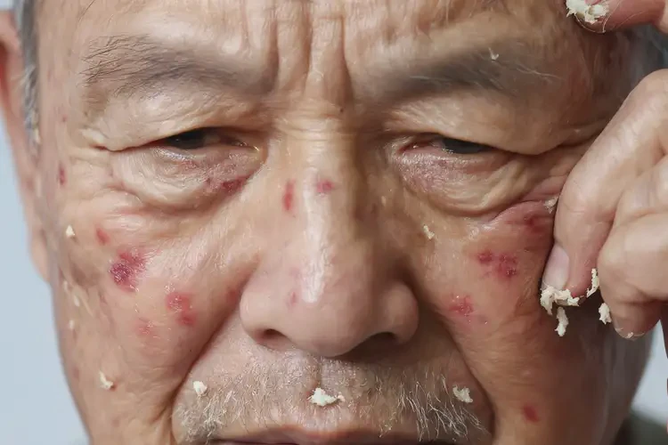 老年人臉上經(jīng)常長濕疹不管它會自己痊愈嗎(圖4)