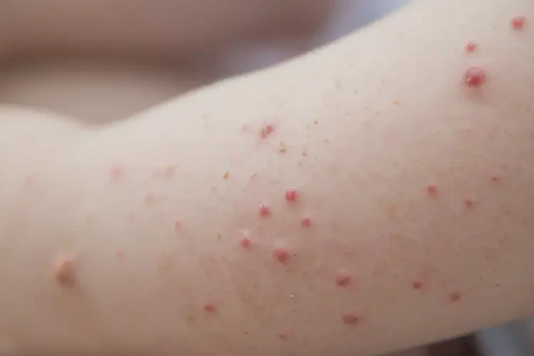 小兒手臂起濕疹可以徹底自愈嗎(圖4)