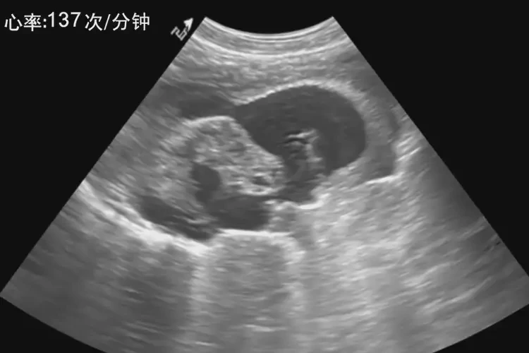 孕27周2天胎心137正常嗎(圖4)