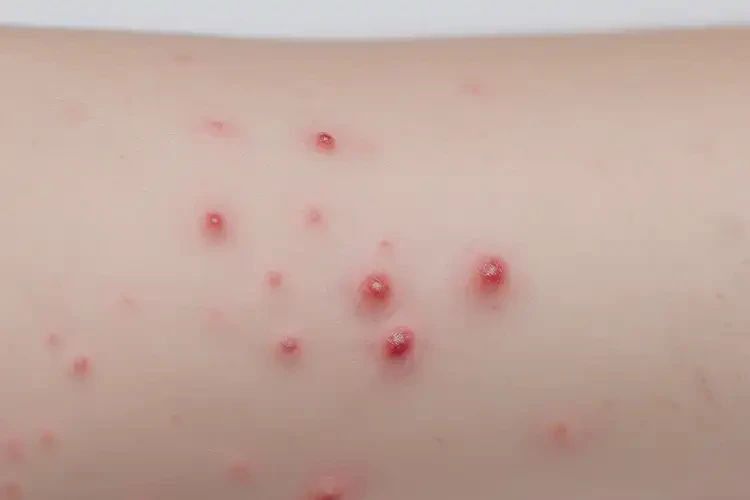 兒童屁股上長濕疹不管它會自己自愈嗎(圖4)