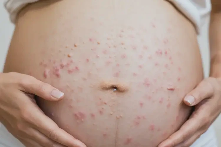 孕婦肚子上偶爾長(zhǎng)濕疹不管它會(huì)自己好嗎(圖4)