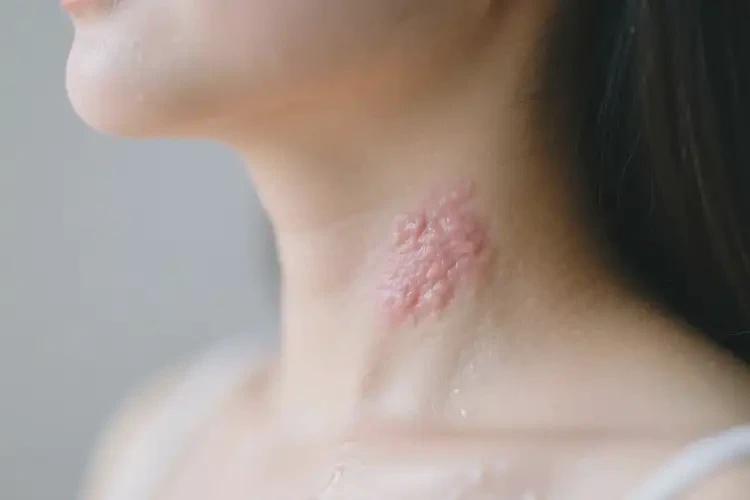 孕婦脖子上偶爾起濕疹不管它會自己痊愈嗎(圖3)