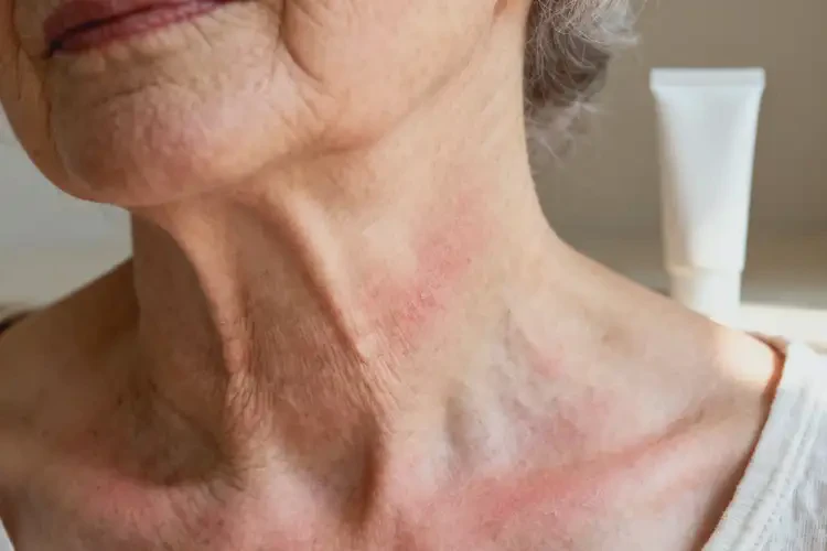 老人脖子上經(jīng)常長(zhǎng)濕疹可以徹底自愈嗎(圖3)
