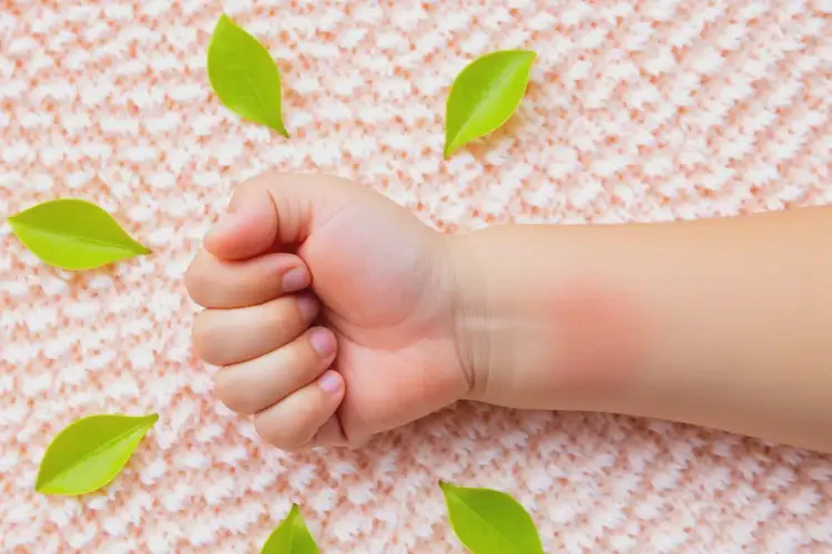 兒童手上容易起濕疹能徹底自愈嗎(圖2)