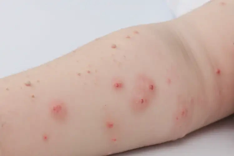 兒童手上出濕疹能夠徹底治愈嗎(圖4)