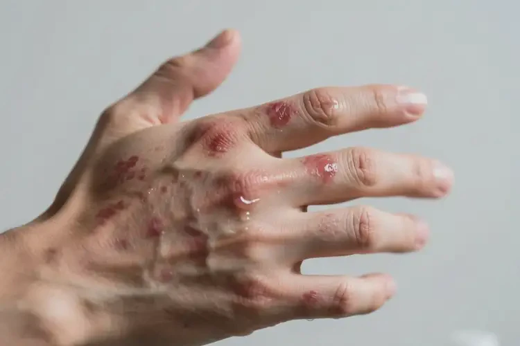 男性手上长湿疹不管它会自己痊愈吗(图3)