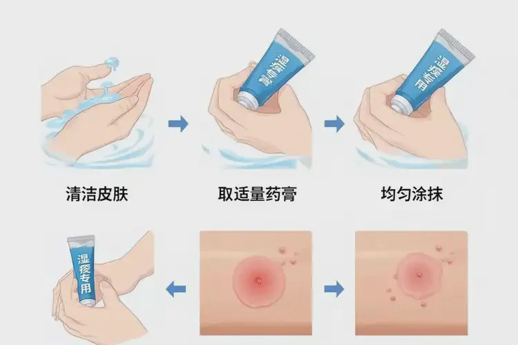 大学生肚子上出现湿疹可不可以彻底自愈(图3)