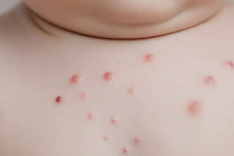 寶寶脖子長(zhǎng)濕疹能靠自己自愈嗎(圖4)