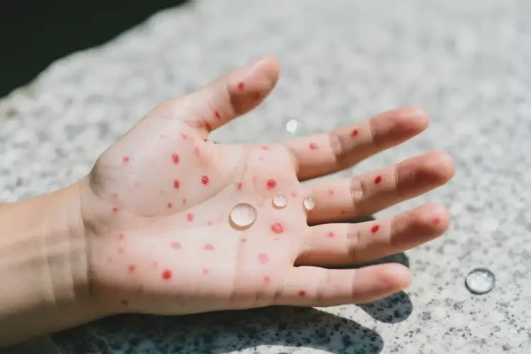 青年人手上偶尔起湿疹不管它会自己好吗(图1)