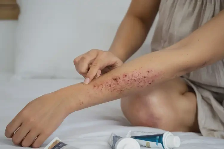 產(chǎn)婦身上起濕疹能徹底自愈嗎(圖4)