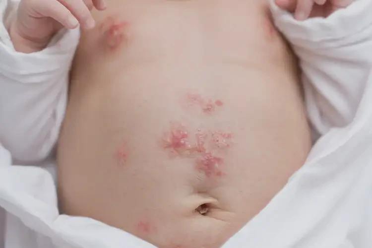 新生儿肚子上经常长湿疹能彻底自愈吗(图4)