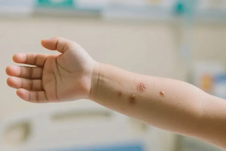 小孩手臂上偶爾起濕疹能夠徹底治愈嗎(圖3)