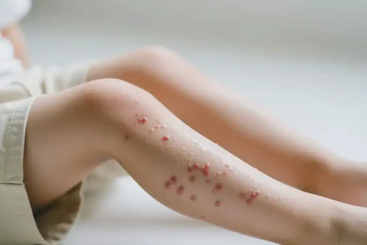 少兒小腿上有濕疹不管它會(huì)自己好嗎(圖4)