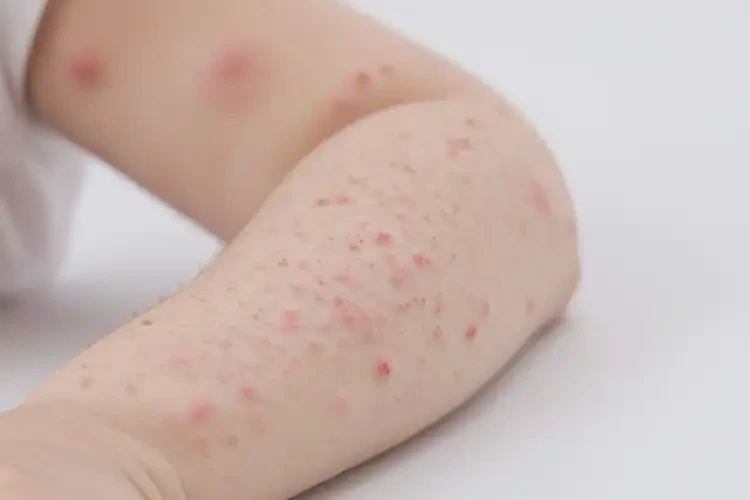 小兒手臂上偶爾長(zhǎng)濕疹不管它會(huì)自己痊愈嗎(圖4)