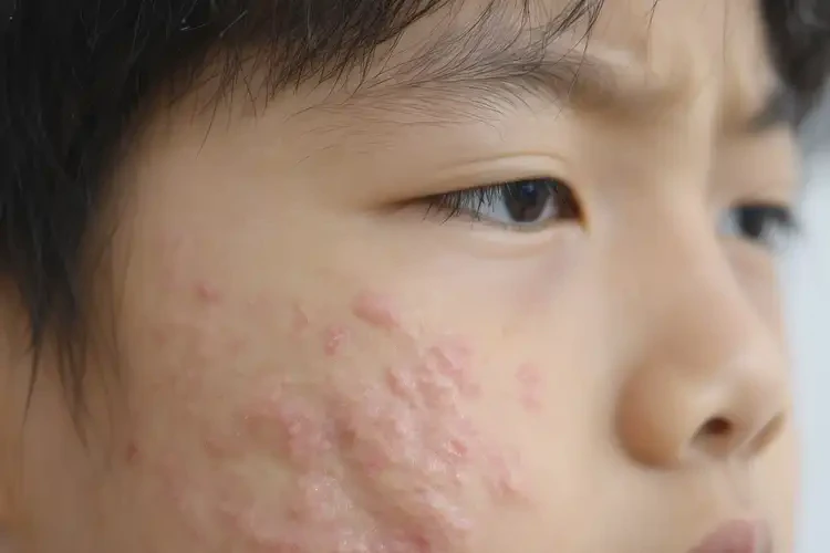 中学生脸上偶尔长湿疹能不能彻底自愈(图4)