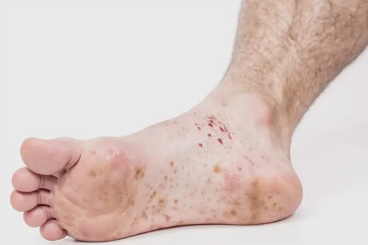 男生腳上偶爾起濕疹不管它會自己自愈嗎(圖3)