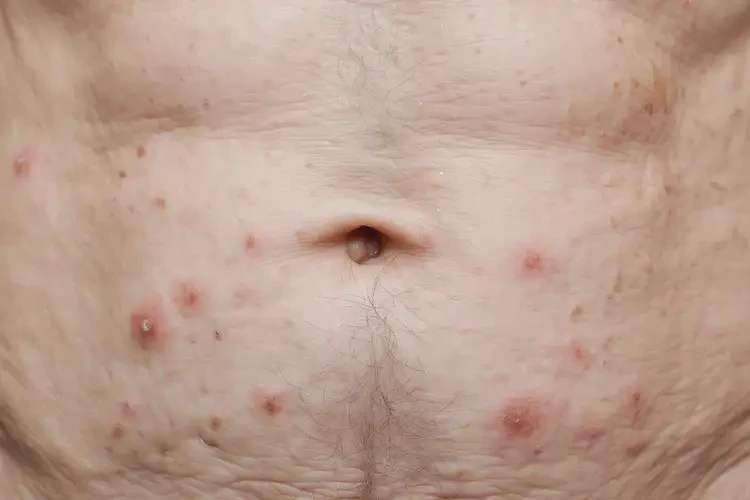 老人肚子上偶爾長濕疹不管它會自己痊愈嗎(圖4)