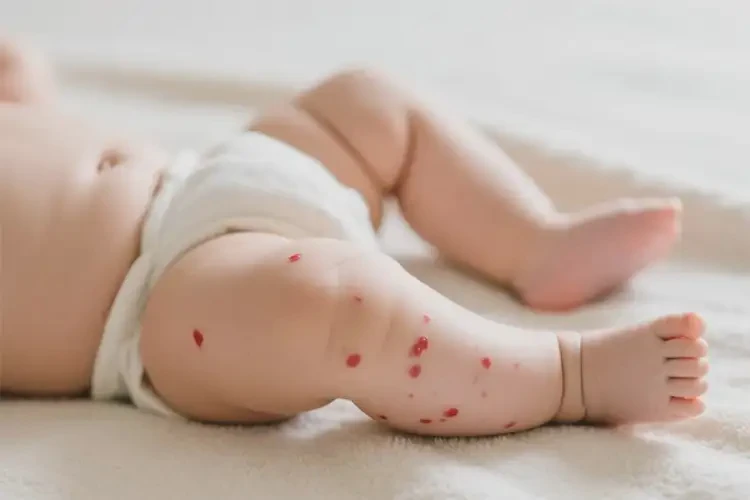 新生兒大腿上長濕疹不管它會(huì)自己痊愈嗎(圖1)