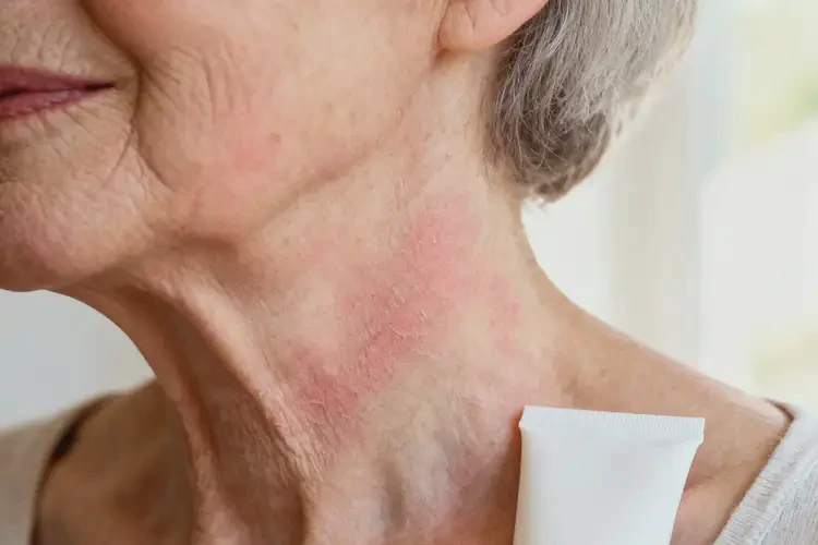 老人脖子上經(jīng)常長(zhǎng)濕疹可以徹底自愈嗎(圖1)