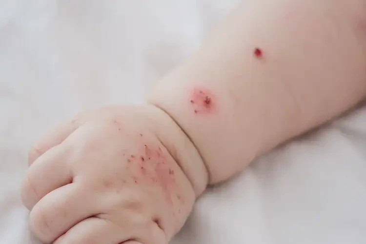 嬰兒手臂長濕疹可以徹底自愈嗎(圖4)