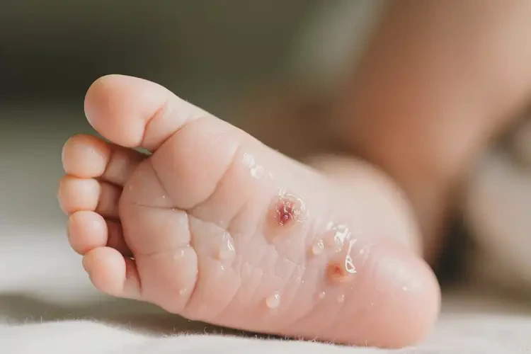 新生兒腳上長濕疹不管它會自己好嗎(圖1)