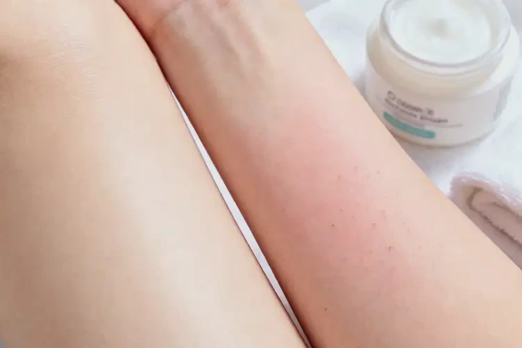 女人身上起濕疹不管它會自己痊愈嗎(圖3)