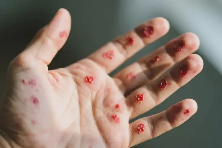 男性手上經(jīng)常起濕疹不管它會自己自愈嗎(圖4)