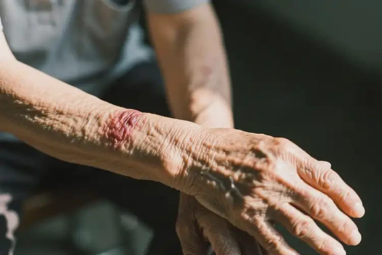 老年人手臂上出現(xiàn)濕疹不管它會(huì)自己好嗎(圖3)