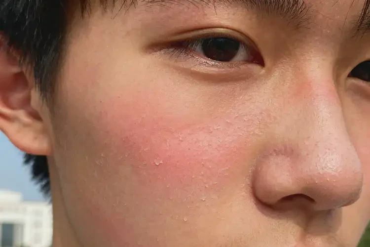 大學(xué)生面部容易起濕疹可以徹底自愈嗎(圖4)