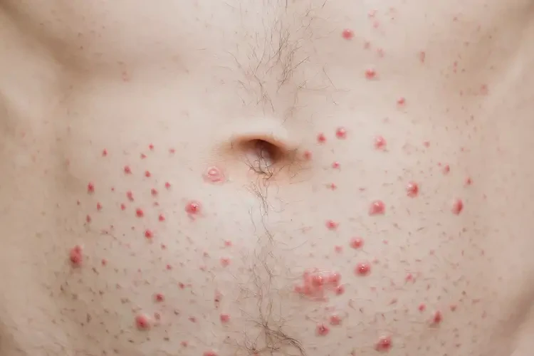 青年人肚子上經(jīng)常長濕疹可不可以徹底自愈(圖4)