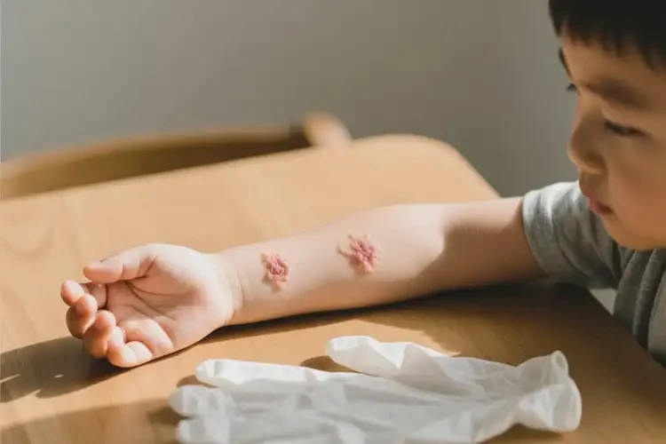 孩子手上出現(xiàn)濕疹不管它會(huì)自己自愈嗎(圖2)