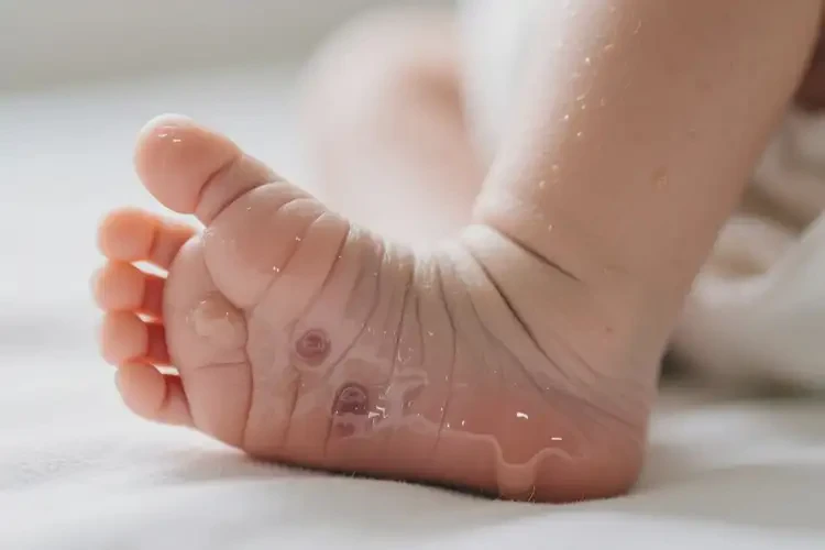 新生兒腳上長濕疹不管它會自己好嗎(圖3)