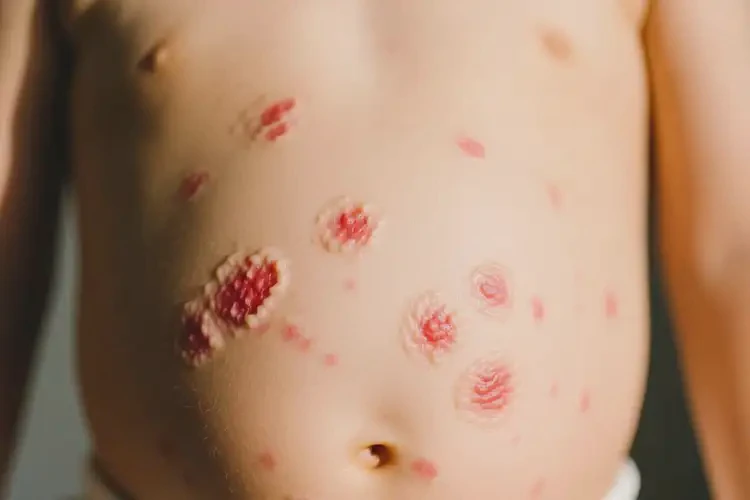 小孩肚子容易起濕疹可以徹底自愈嗎(圖2)
