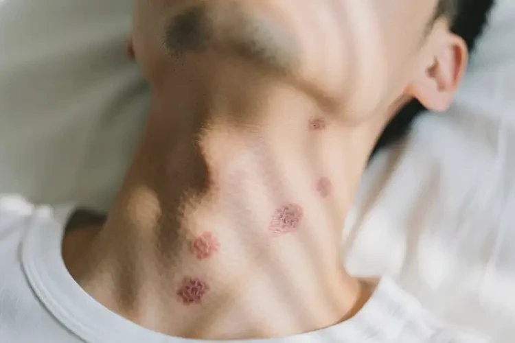 男性脖子經(jīng)常長濕疹能靠自己自愈嗎(圖1)