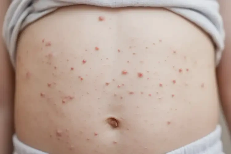 小孩肚子偶爾長濕疹不管它會自己好嗎(圖4)