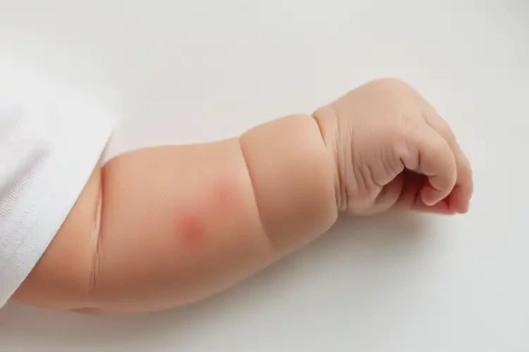 嬰兒手臂上偶爾長濕疹能徹底自愈嗎(圖2)