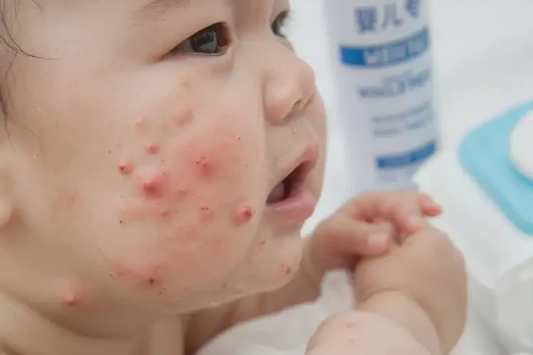 嬰兒面部經(jīng)常起濕疹不管它會自己好嗎(圖4)