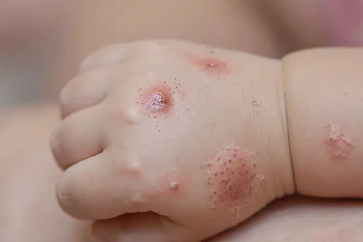 儿童手上偶尔长湿疹能彻底自愈吗(图4)