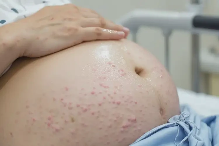 產(chǎn)婦肚子上偶爾長濕疹不管它會自己好嗎(圖2)