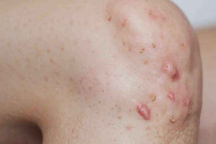 中學生大腿起濕疹可以徹底自愈嗎(圖4)