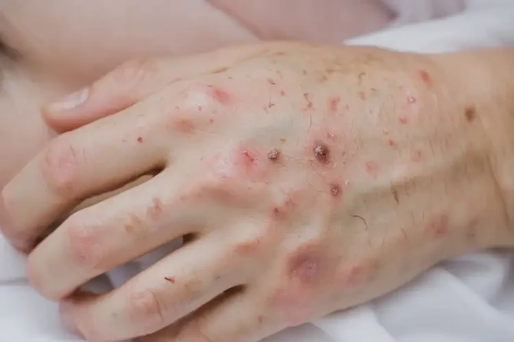 產(chǎn)婦手上經(jīng)常長(zhǎng)濕疹可不可以徹底自愈(圖3)